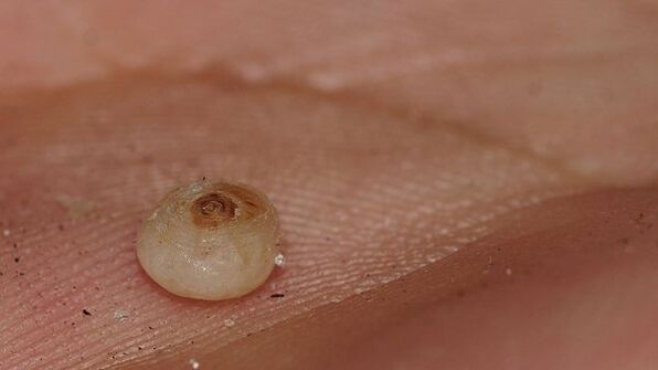 Sarkopsilose mit subkutanen Parasiten